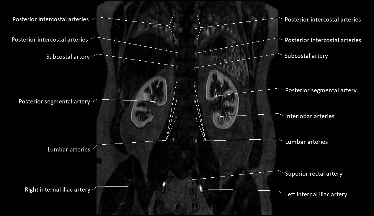 MRA Abdomen coronal anatomy image 39.webp